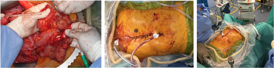 Cytoreduction surgery with hyperthermic intraperitoneal chemotherapy (HIPEC) for a patient with pseudomyxoma peritonei