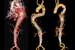CT angiography with 3D reconstruction of thoracoabdominal aortic aneurysm pre- and post- endovascular repair.