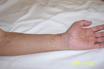 Wound of endoscopic radial artery harvest