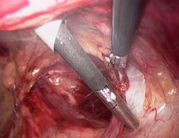 Needleoscopic Total Extra-Peritoneal (TEP) Hernioplasty with 3mm instruments