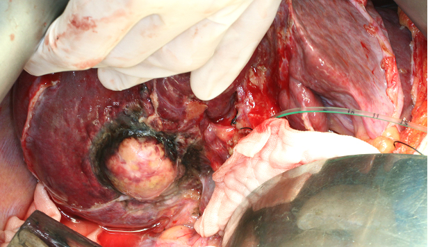 Open radiofrequency ablation with bile duct cooling