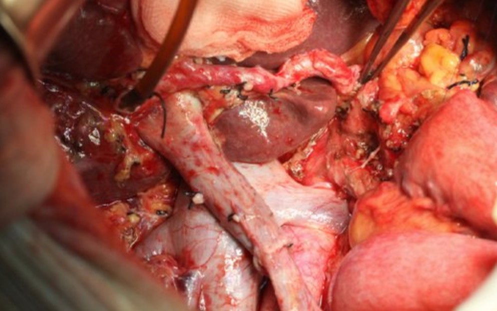 Whipple operation with vascular reconstruction