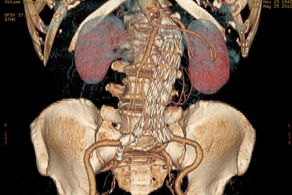 A 3D CT reconstruction of the abdomen after an EVAR operation