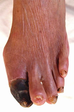 Left big toe gangrene in a patient with diabetes mellitus due to infra-popliteal occlusive disease