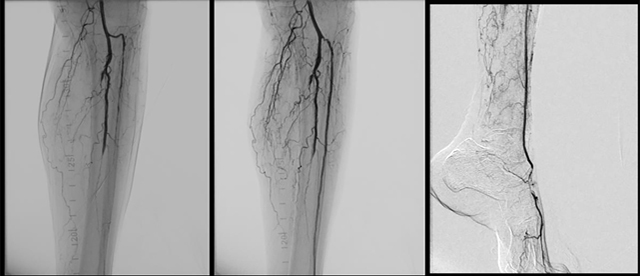 Angiogram of infra-popliteal and anterior tibial arteries, which supply the foot. The anterior tibial artery is severely narrowed. Balloon Angioplasty is performed which restored its patency and hence the blood supply to the foot