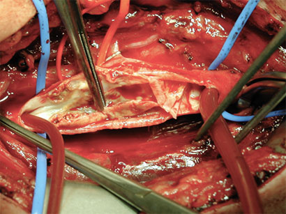 Close-up view of the carotid artery during endarterectomy. The internal carotid artery is opened up and the plaque is being removed