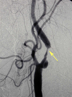 Angiogram of the carotid artery showing critical stenosis in the internal carotid artery (yellow arrow)