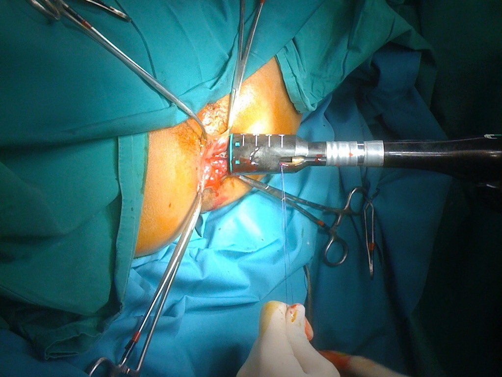 Stapled haemorrhoidectomy