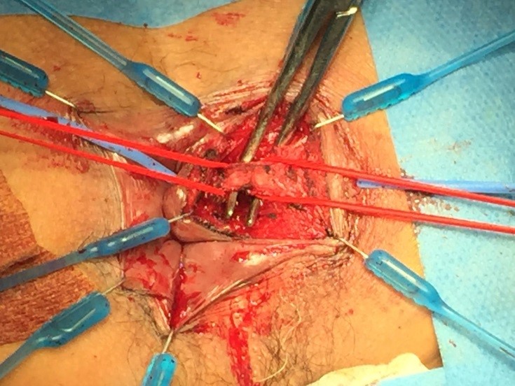 Ligation of Intersphincteric Fistula Tract (LIFT) procedure