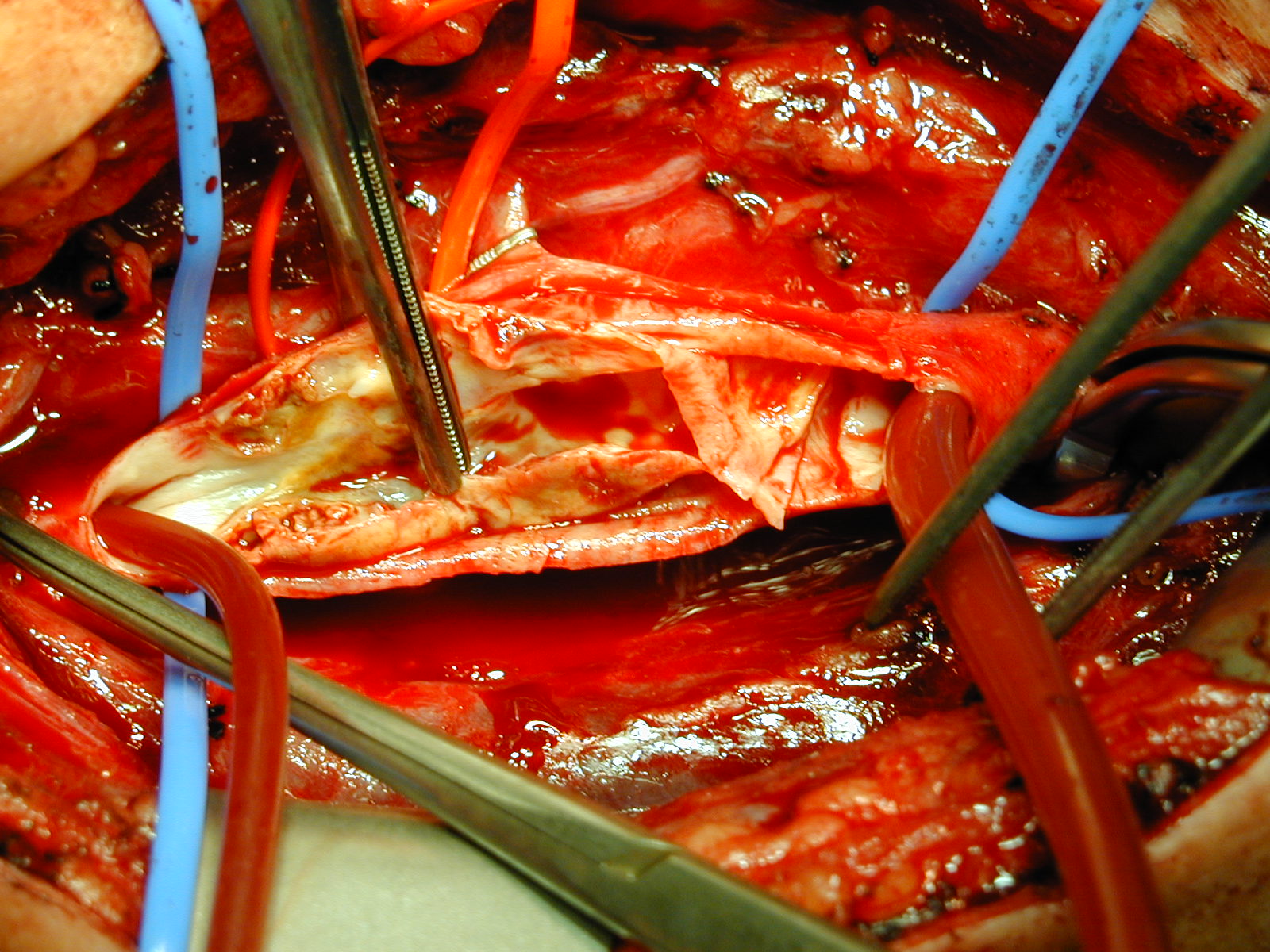 Carotid Endarterectomy. The carotid artery has been isolated and a shunt has been inserted to maintain blood flow. The atherosclerotic plaque would be removed along with the inner layer of the vessel wall to restore patency and arterial flow to the brain.