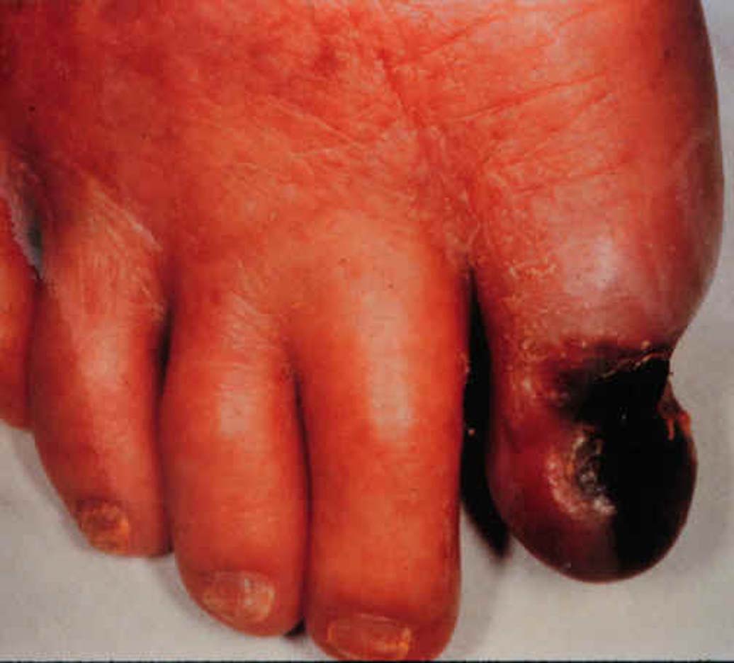 A gangrene toe. If atherosclerotic occlusive disease in the lower limb is left untreated, tissues may die due to a lack of oxygen supply. 