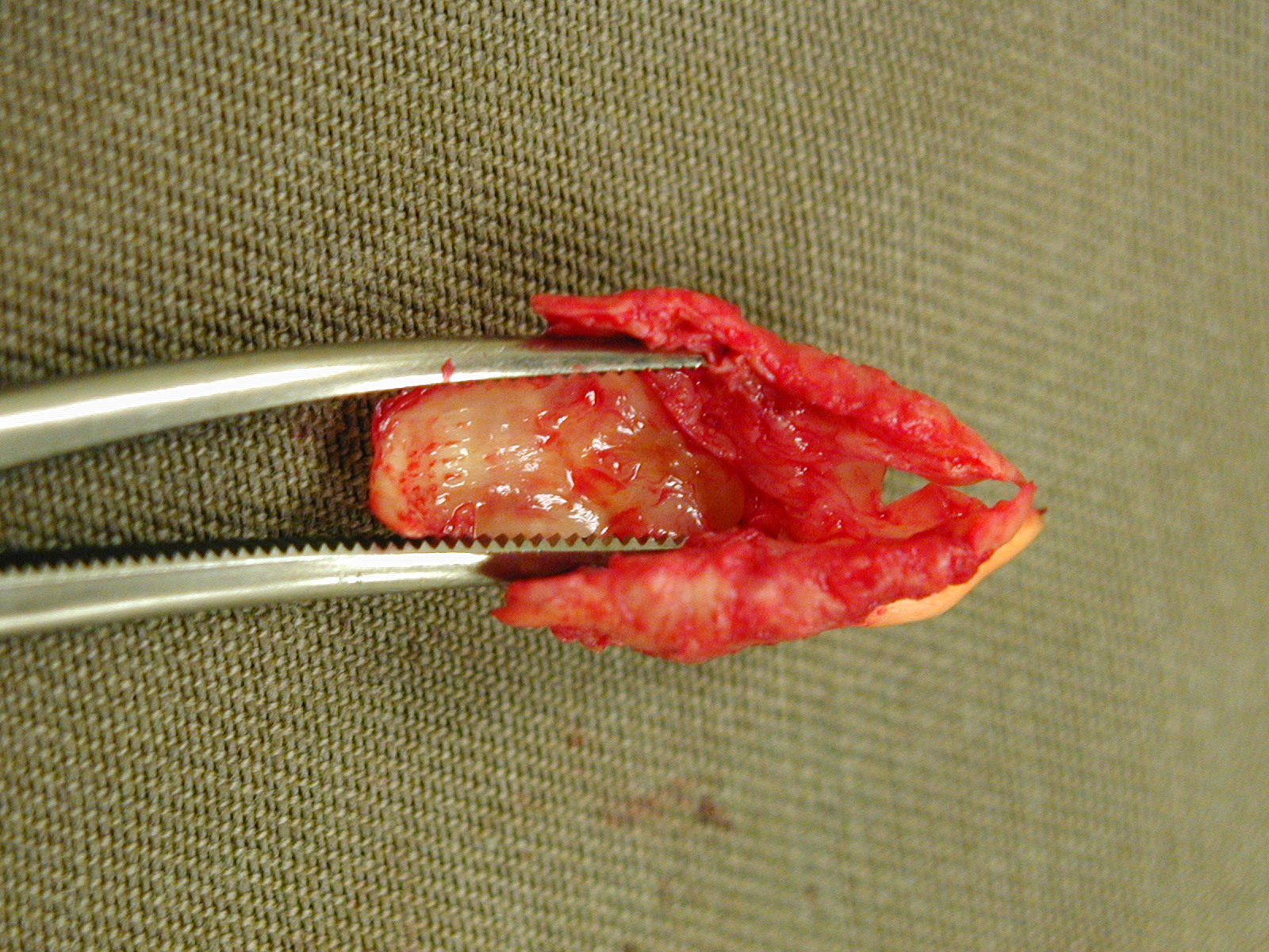 Atherosclerotic Plaque. This is a piece of fibrous plaque removed during carotid endarterectomy. Such lesions are most commonly found at the carotid bifurcation. They are caused by infection of the intimal-medial layers, resulting in an accumulation of lipids, macrophages, and fibrous tissue. Over time, they may develop into necrosis, ulceration, or hemorrhage.