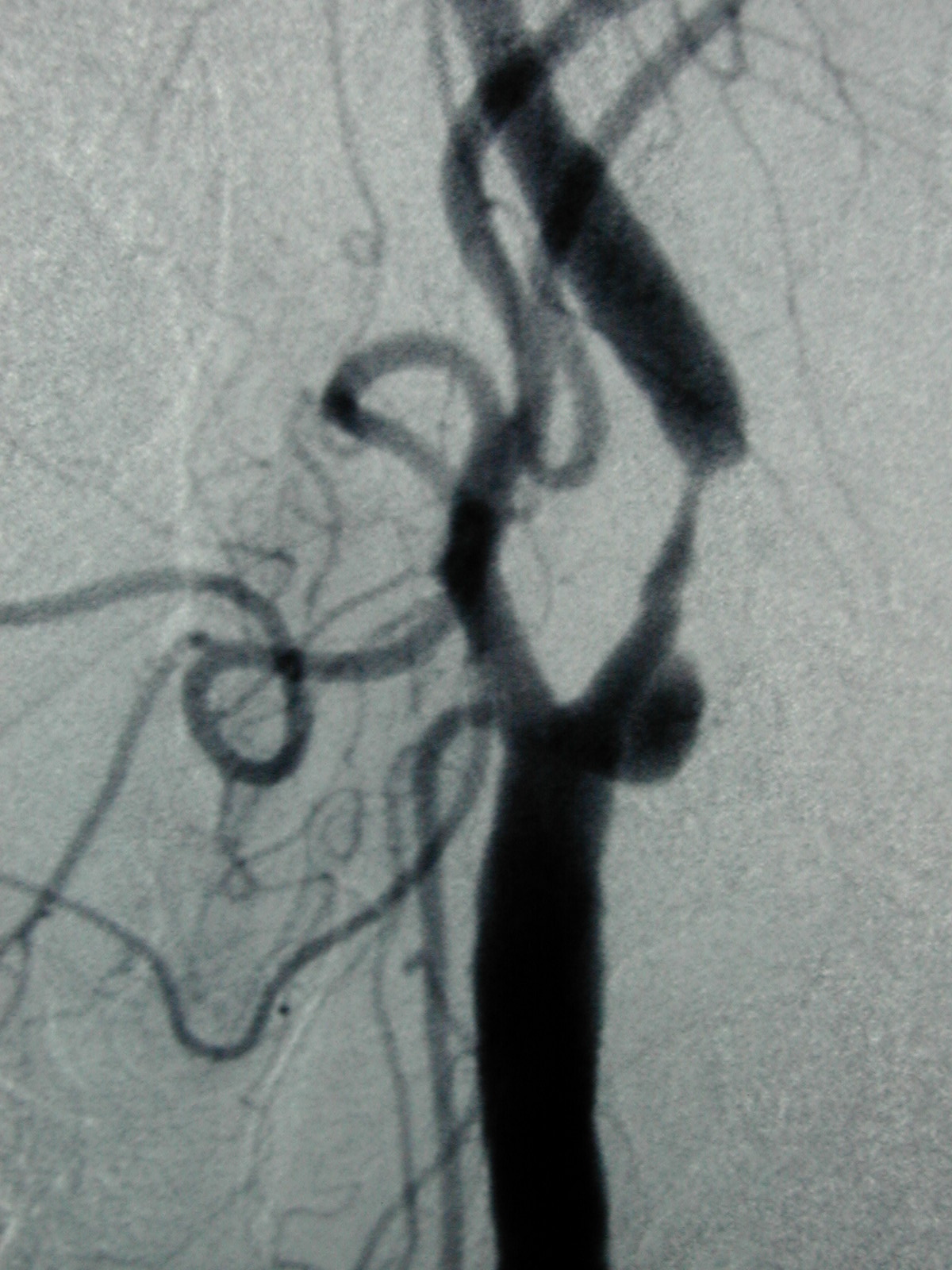 A severe stenosis in the internal carotid artery (ICA). The ICA is one of the main arteries that feeds the eyes and parts of the cerebral hemispheres. Scarce supply of blood to these areas may lead to strokes. 