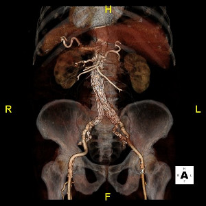CT angiography with 3D reconstruction of abdominal aortic aneurysm post- endovascular repair.