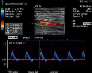 Duplex image of a superficial femoral artery post angioplasty and insertion of a nitinol stent.