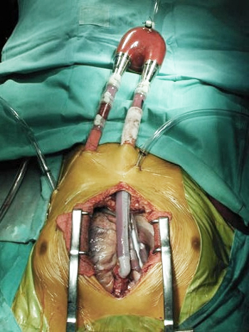 LVAD LVAD