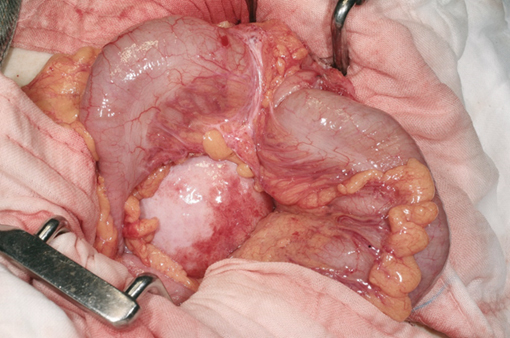 Large invasive adrenal tumor