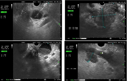 Endoscopic ultrasound image