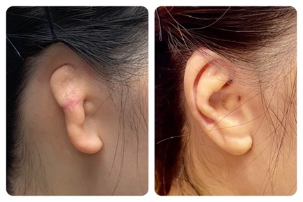 Costal cartilage reconstruction