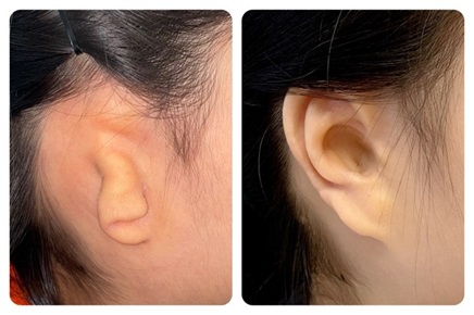Implant-based reconstruction