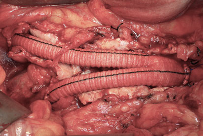 Number of hepatic resections performed over the past 28 years