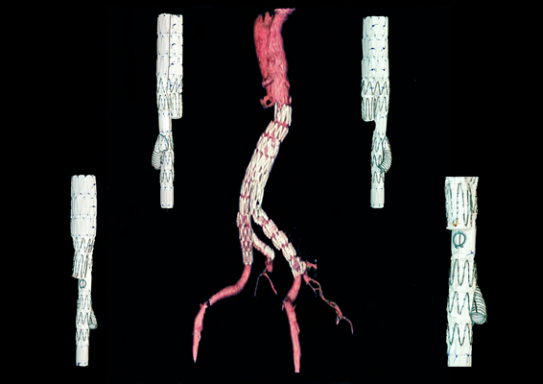 Iliac branched device