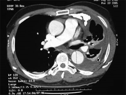 CT Scan of thoracic aortic dissection. A flap with fenestration divided aorta into true and false lumen