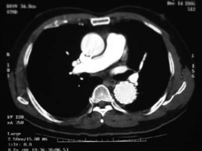 Complete resolution of aortic dissection with TEVAR