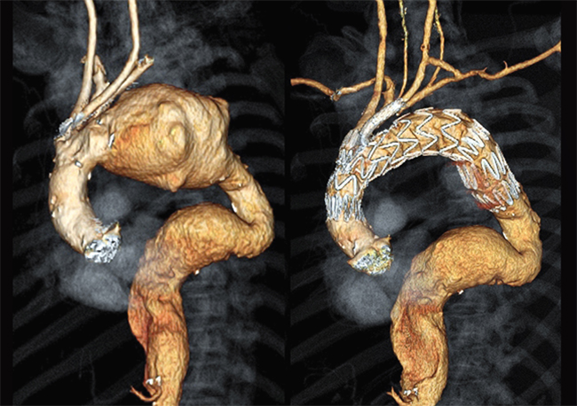 Thoracic aortic arch-branched TEVAR with left carotid to left subclavian bypass for treatment of proximal aortic arch aneurysm