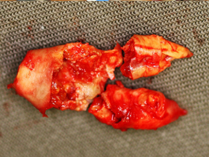 Close up view of the atherosclerotic plaque removed