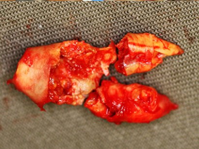 Close up view of the atherosclerotic plaque removed Close up view of the atherosclerotic plaque removed