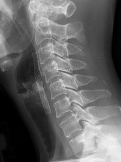 Lateral neck X-ray showing a carotid stent in place