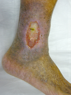 Management of venous ulcer requires collaboration between vascular surgeons, wound care specialists and microbiologists
