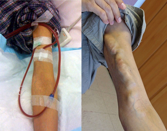 Elbow arteriovenous fistula (AVF) - An anteriorly transposed basilic vein form the medial arm is anastomosed to brachial artery at elbow forming a brachio-basilic AVF. The AVF is needled for haemodialysis. Elbow arteriovenous fistula (AVF) - An anteriorly transposed basilic vein form the medial arm is anastomosed to brachial artery at elbow forming a brachio-basilic AVF. The AVF is needled for haemodialysis.