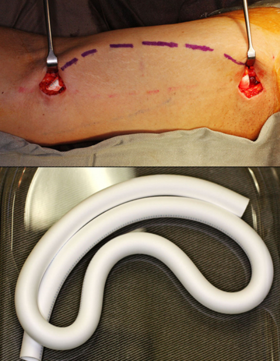 Arteriovenous graft (AVG) - A synthetic Gortex graft is used for creation of a brachial artery to brachial vein AVG