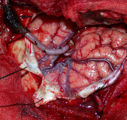 Neurovascular surgery